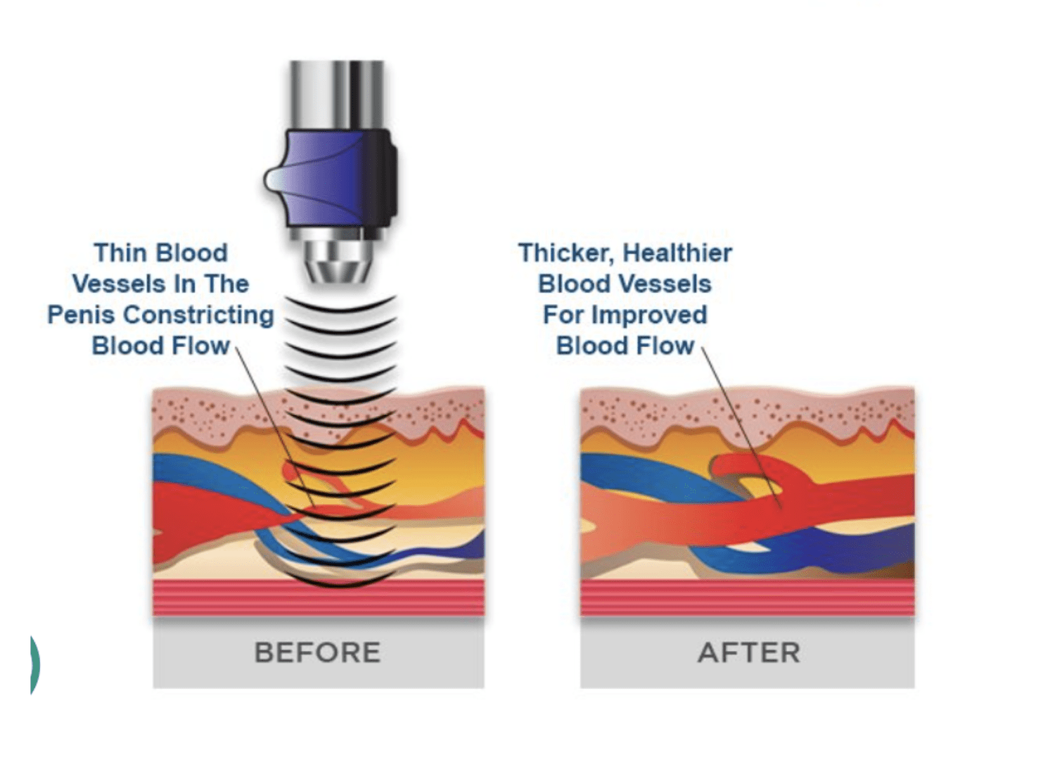 SoundWave Therapy: A Non-Invasive Solution for Erectile Dysfunction