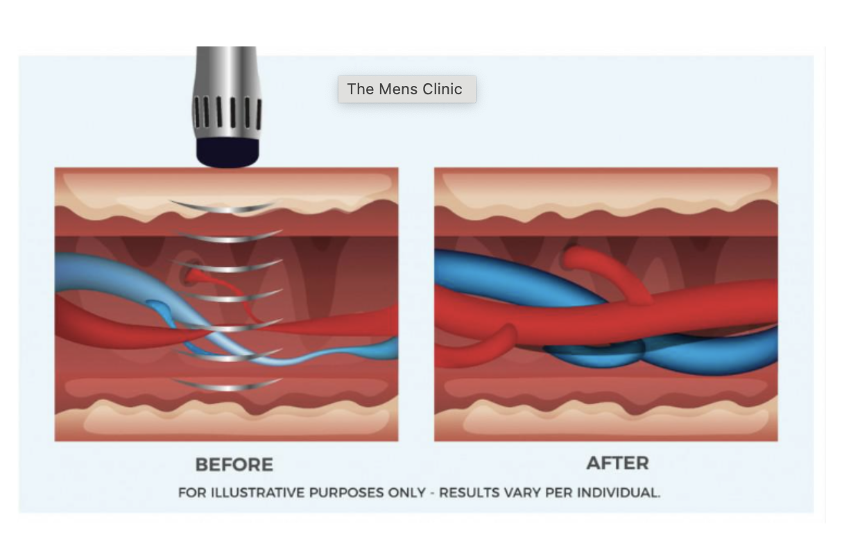 Shockwave Therapy for ED Near Me: Is It Right for You?